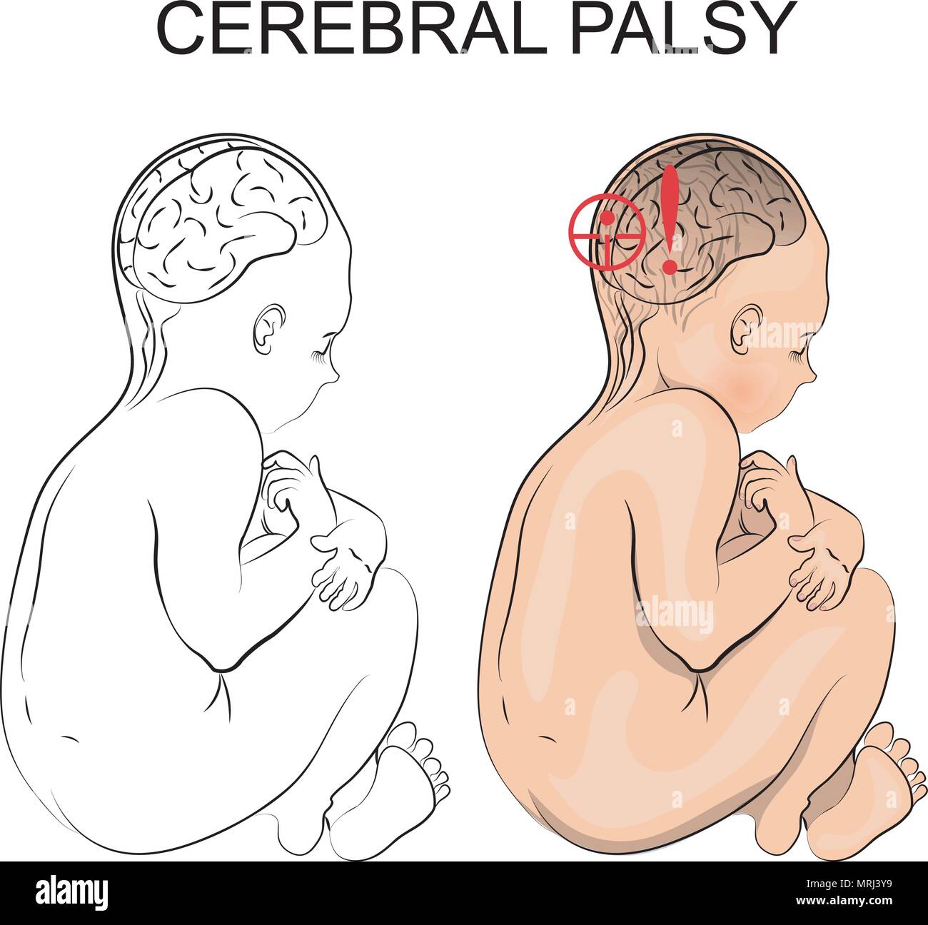 Illustration du patient avec la paralysie cérébrale. Enfant. Illustration de Vecteur