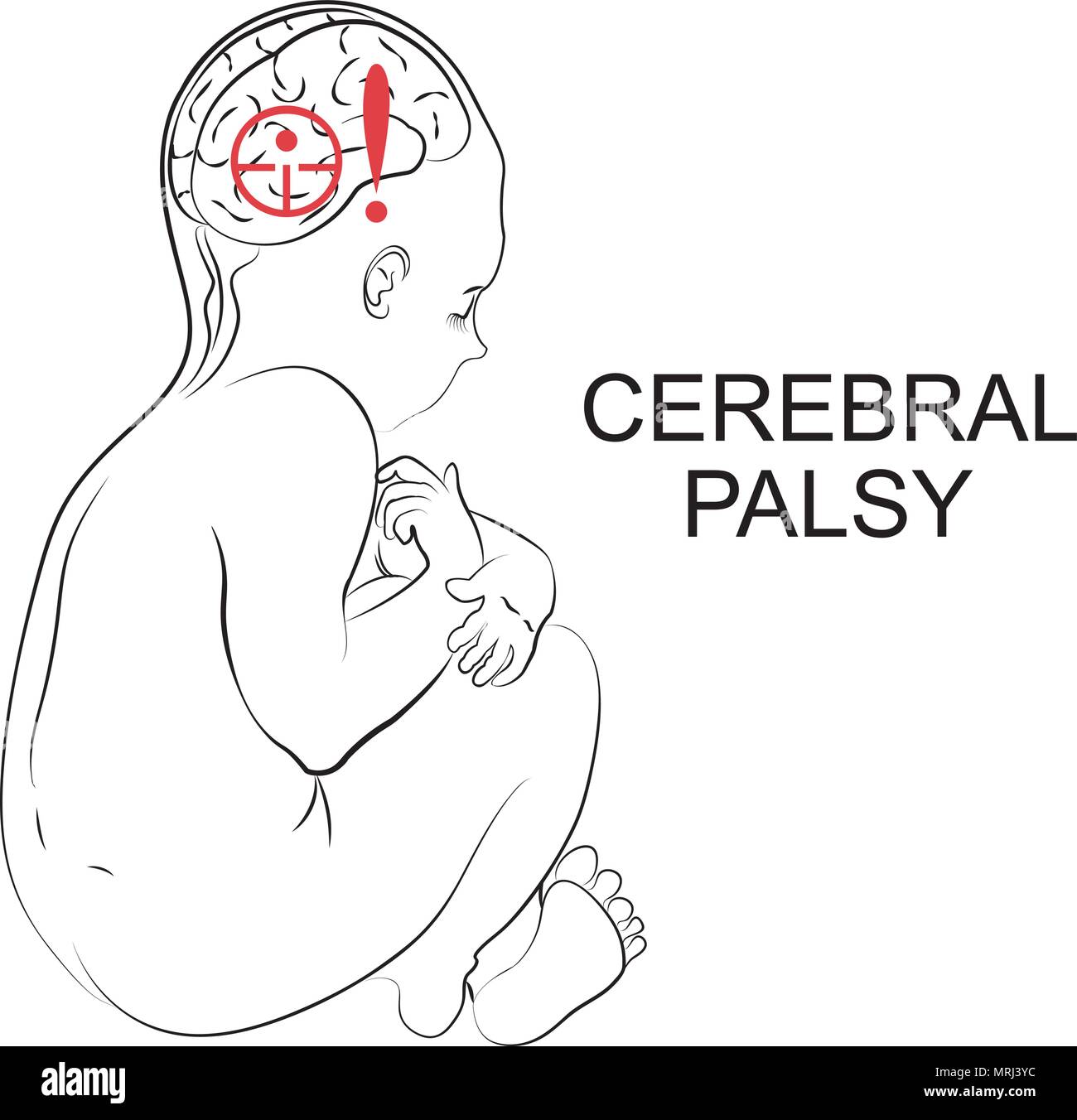 Illustration du patient avec la paralysie cérébrale. Enfant. Illustration de Vecteur