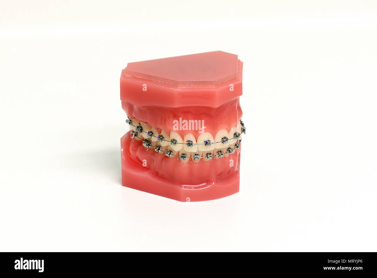 Moule orthodontique d'un appareil dentaire montrant un ensemble de la haute et de la accolades métalliques joints à dents pour le redressage et l'alignement sur les mesures correctives Banque D'Images
