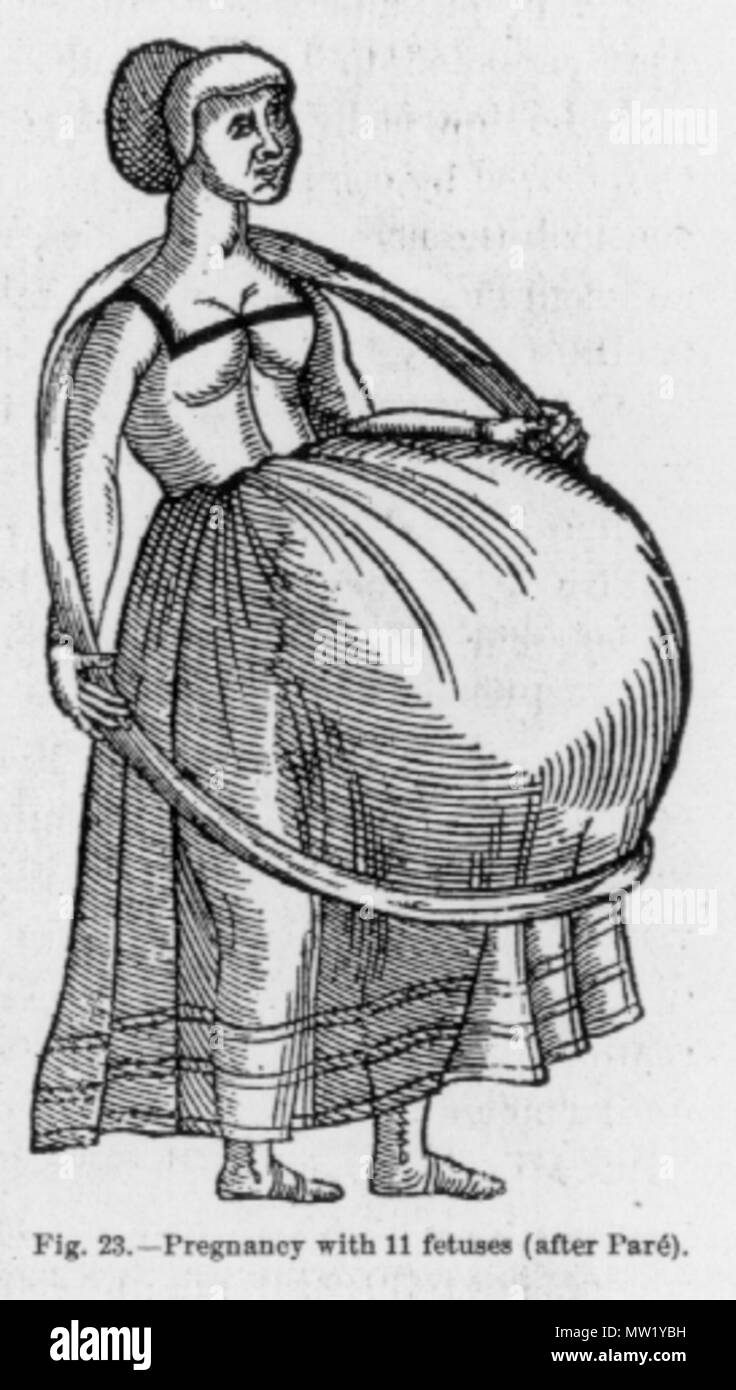 . Image caption : 'La grossesse avec 11 fœtus (après avoir Paré).' Giovanni Pico della Mirandola (1463-1494) ont rapporté le cas d'une femme Italienne, Dorothea, qui auraient donné naissance à undecaplets après avoir donné naissance à nonuplets. Cette illustration est une copie d'un original par Ambroise Paré à partir de l'édition 1900 d'Anomalies et curiosités de la médecine par George M. Gould et Walter L. Pyle. le 1900. Ce fichier n'est pas informations sur l'auteur. 620 Undecaplets Banque D'Images