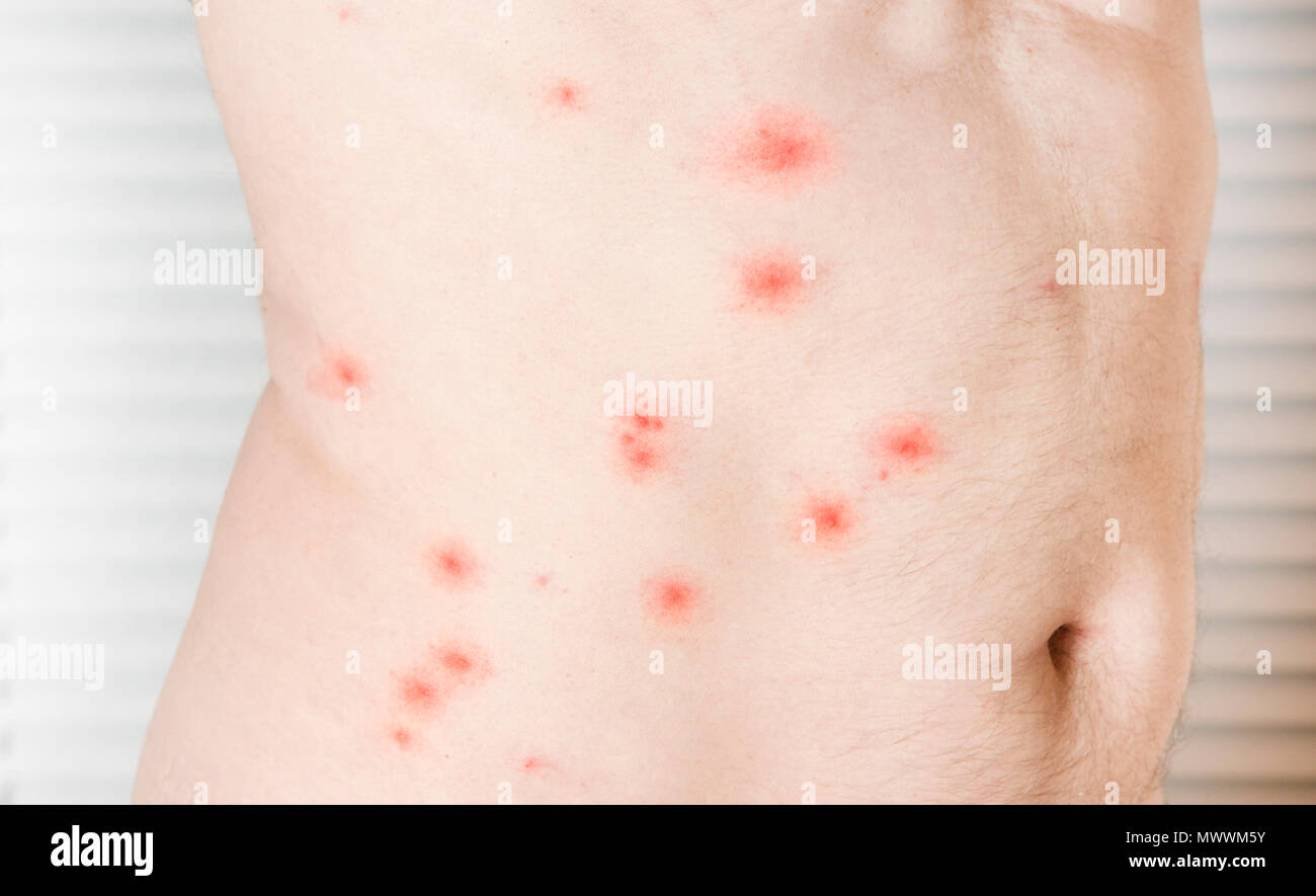 Les piqûres sur un gros plan de la peau de l'homme blanc Photo Stock — free download