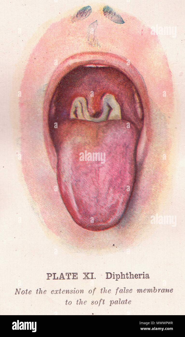 . Anglais : entre les pages 270 et 271, cette illustration de la gorge, de la bouche et de la langue est de montrer des signes de la diphtérie. Titre Le guide pratique sur la santé : un traité sur l'anatomie, la physiologie, et de l'hygiène, avec une description scientifique des maladies, leurs causes et traitement : conçu pour les infirmières et pour une utilisation à domicile Auteur Frederick Magee Rossiter Editeur Pacific Press Pub. Assn., 1913 Longueur 660 pages de données Flickr le 2011-08-17 : Tags : domaine public, image, dessin, illustration, affiche, livre, médicaux, le Guide pratique pour la santé Licence : CC BY 2.0 : perpetualplum Sue Clark . 1913 Banque D'Images