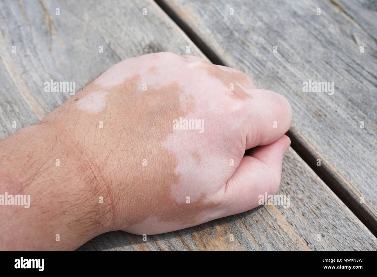 La main des hommes avec le vitiligo état de peau, caractérisée par des taches blanches ou des correctifs non pigmentée Banque D'Images