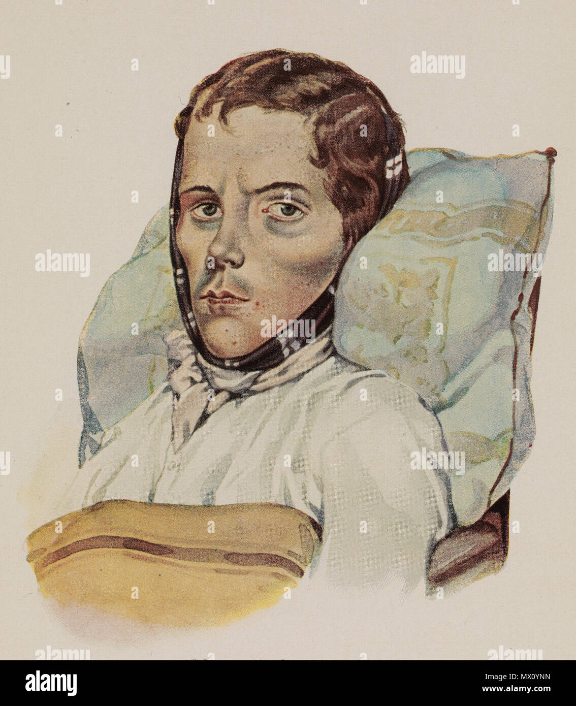 L0074300 homme atteint de tuberculose pulmonaire, Baumgartner, 336 Karl Sandhaas Karl Heinrich Baumgärtner Schwindsüchtiger Banque D'Images