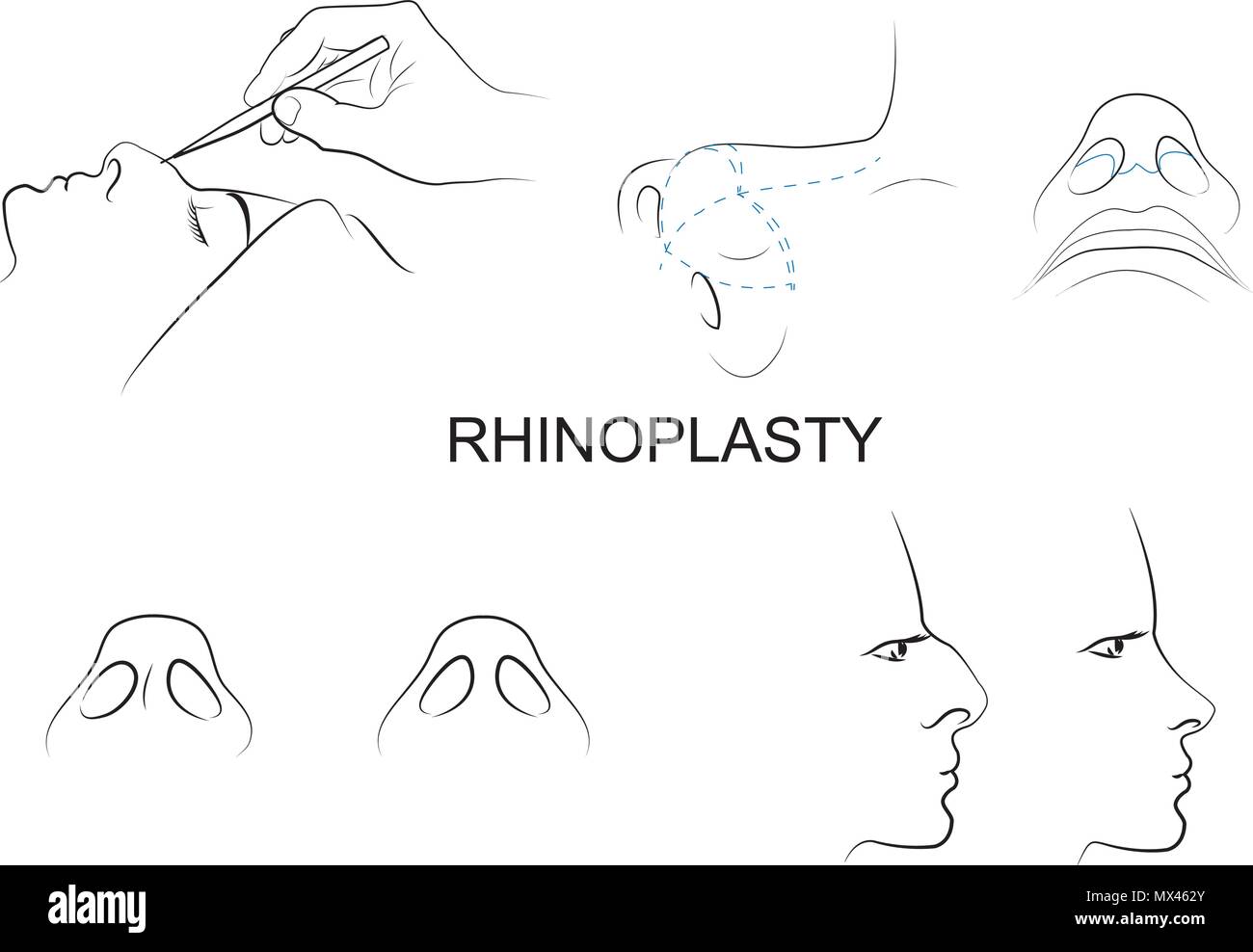 Illustration de la rhinoplastie. chirurgie esthétique. médecine esthétique. vector Illustration de Vecteur