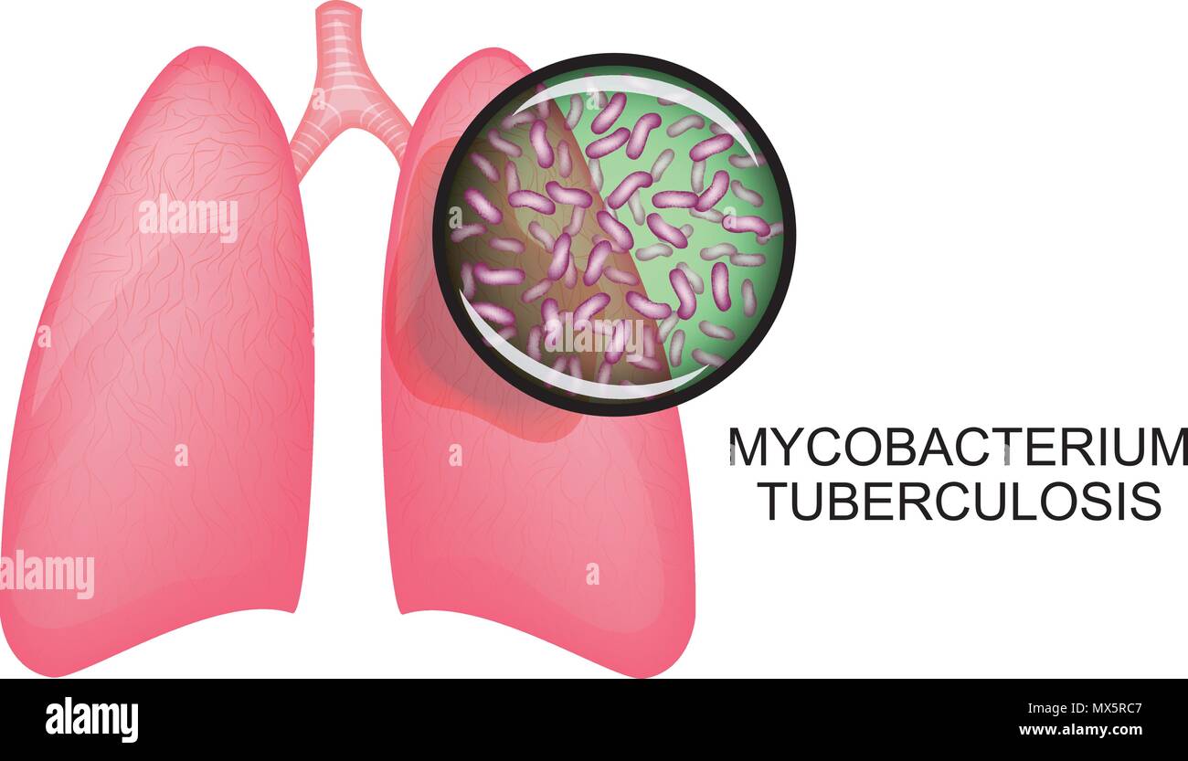 Illustration des poumons d'un malade de la tuberculose. Mycobacterium tuberculosis Illustration de Vecteur