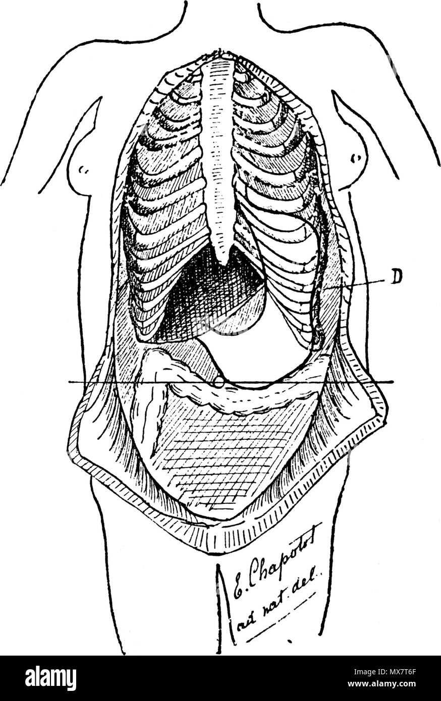 . English : Figure 18 (d'après nature). ESTOMAC AVEC BILOCULATION VERTICALE. D. Déformation du thorax, correspondant au rétrécissement de l'estomac. On voit les côtes déformées, faisant l'angle de l'onu en avant de la ligne axillaire ; the vendeurs-inclinées en bas. 1892. Le Dr Eugène Chapotot 197 EstomacCorset page068 Banque D'Images