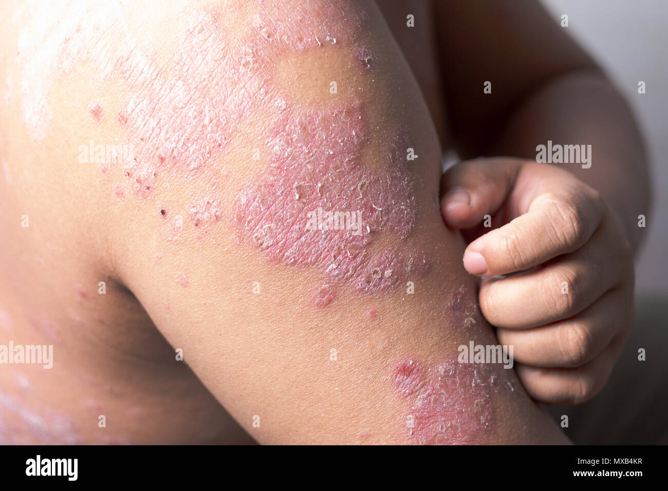 Les hommes sont à l'aide de ses mains pour se gratter le bras des ulcères. Maladies causées par des anomalies de la lymphe. Le psoriasis est une maladie de la peau. Banque D'Images