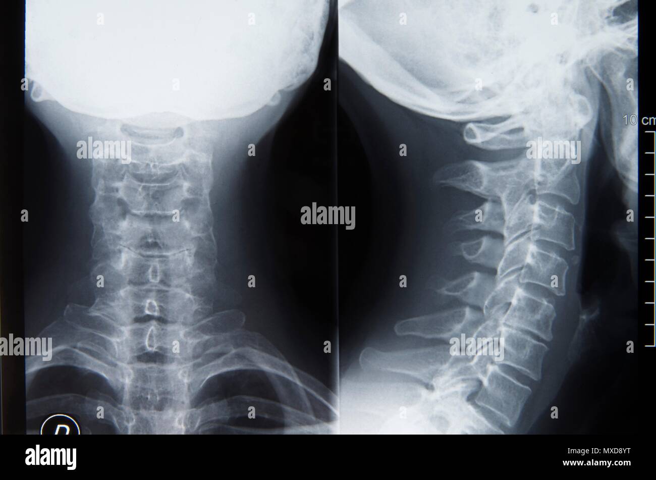 Analyse des radiographies du rachis cervical mettant en évidence l'alignement vertébral et les anomalies potentielles Banque D'Images