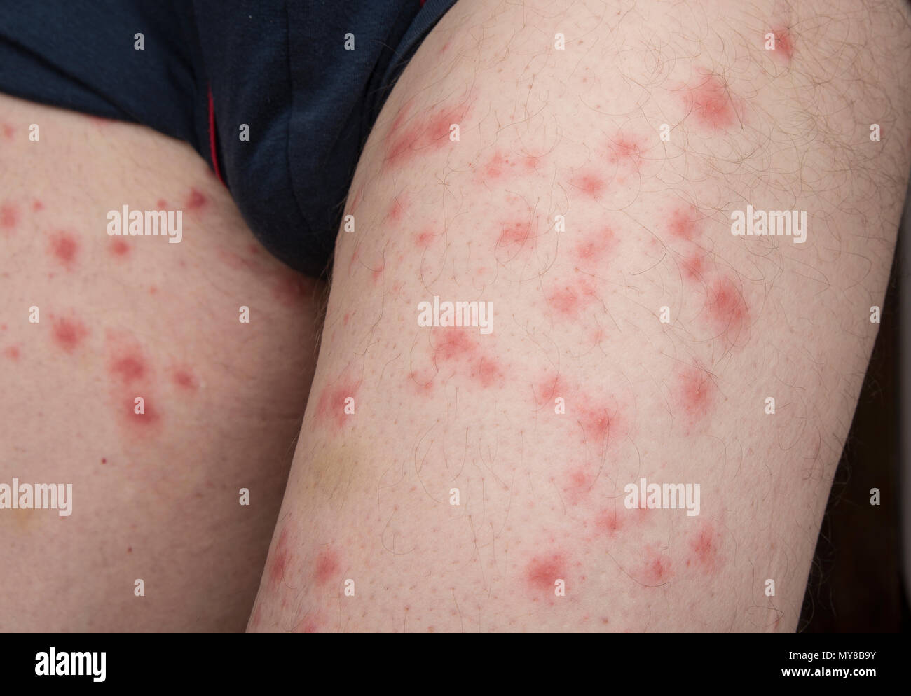 Piqûres d'insecte sur corps de l'homme. Des punaises de lit ou de brocante. Banque D'Images