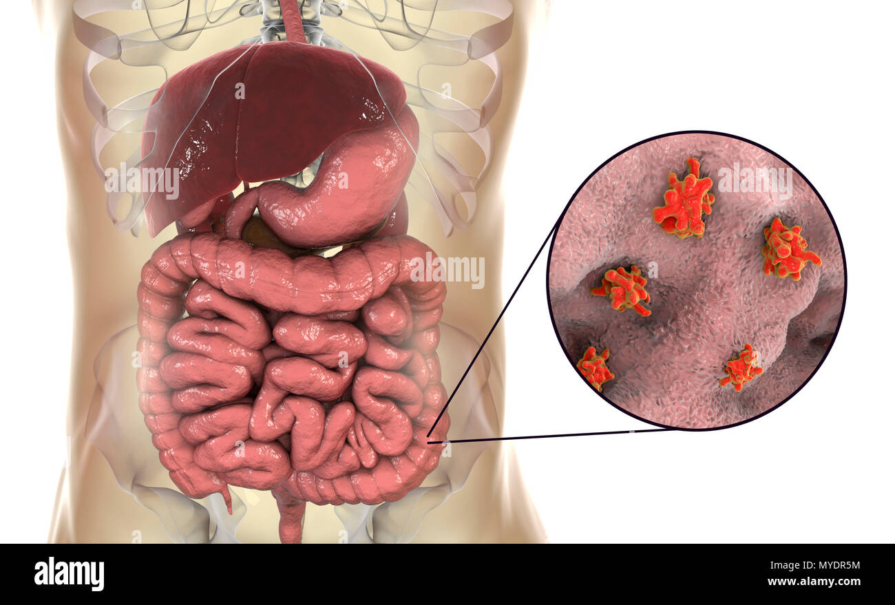 Amibe parasitaire (Entamoeba histolytica) dans le gros intestin, l'illustration de l'ordinateur. Cet organisme unicellulaire la dysenterie amibienne et ulcères (stade végétatif) trophozoïte. Il se transmet par contamination fécale des aliments et de l'eau et est plus commun où l'assainissement est pauvre. Les amibes envahissent l'intestin mais peut se répandre sur le foie, les poumons et d'autres tissus. L'infection est provoquée par l'ingestion de kystes qui se développent dans l'amibe trophozoïte pathogènes vus ici. Entamoeba histolytica est présente dans le monde entier, avec jusqu'à 50 % de la population infectée, principalement dans les climats chauds. Banque D'Images