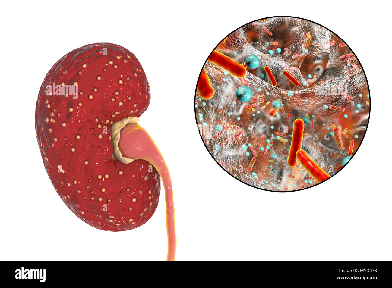 La pyélonéphrite aiguë. Illustration de petits abcès (jaune) sur la surface d'un rein dans un cas de pyélonéphrite aiguë. Les bactéries, les agents pathogènes d'une pyélonéphrite aiguë, sont vus en gros plan. La pyélonéphrite peut être aiguë ou chronique. La forme aiguë est habituellement causée lorsque les bactéries causant la propagation cystite uretères dans la vessie. Elle provoque de la fièvre et des douleurs au dos. Les causes les plus communes sont Escherichia coli, Enterococcus sp., Streptococcus sp., Staphylococcus sp. ou. Le traitement est avec des antibiotiques. Banque D'Images