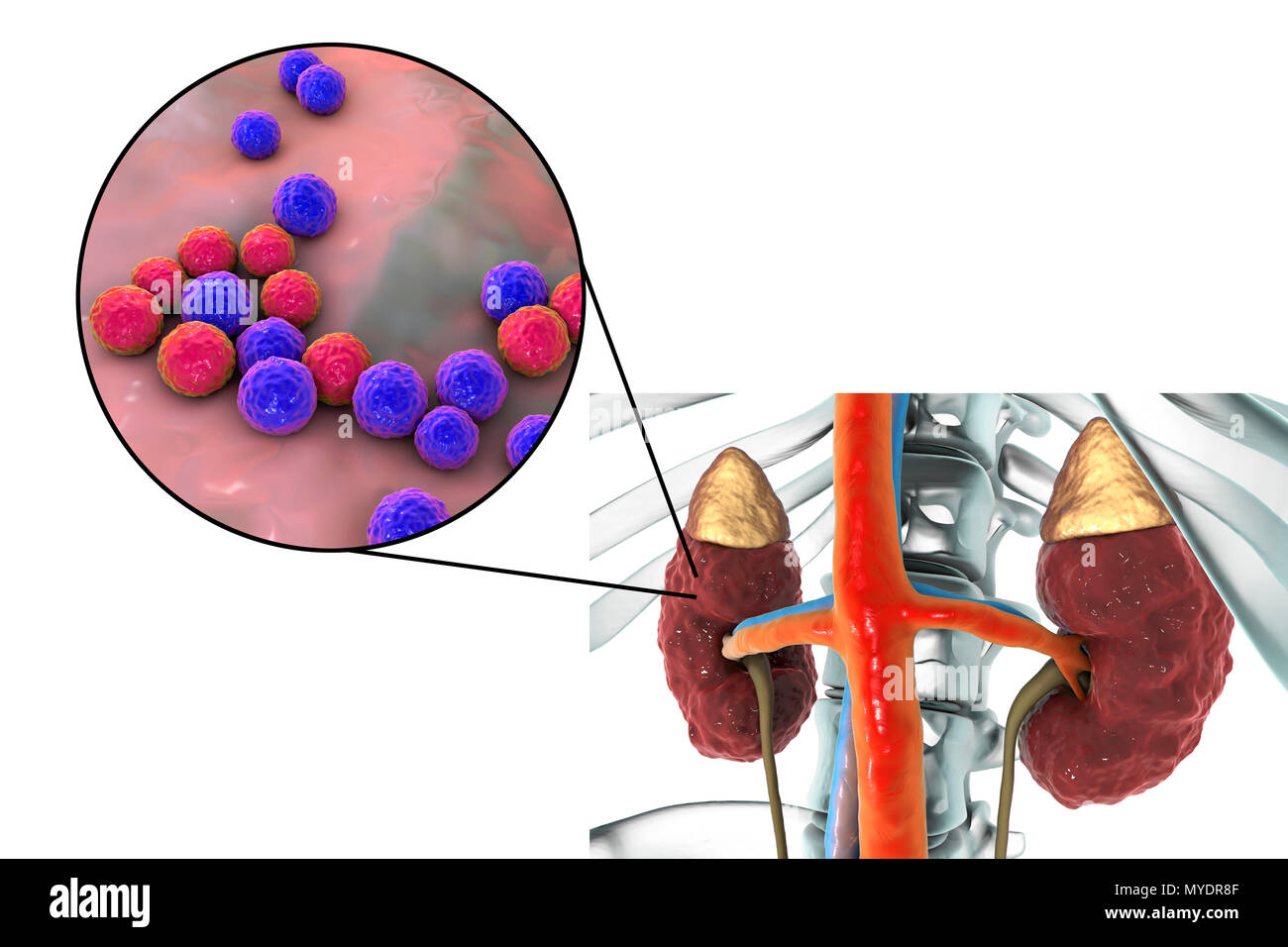 La pyélonéphrite chronique causée par Enterococcus sp. des bactéries. Illustration montrant l'irrégularité marquée surface corticale du rein et une vue rapprochée de bactéries entérocoques. Banque D'Images