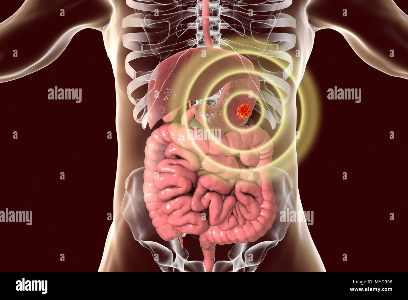 Traitement du cancer de l'estomac humain, ordinateur conceptuel illustration. Banque D'Images