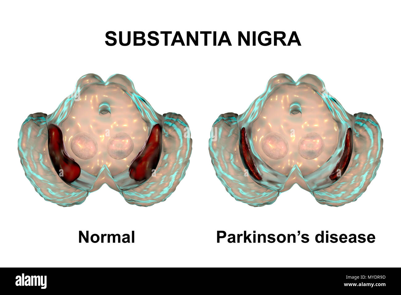 La substantia nigra. Illustration de l'ordinateur une substance noire (en haut) et pervertissaient la substantia nigra (bas) à partir de cerveaux humains. La substantia nigra joue un rôle important dans la récompense, la toxicomanie, et de mouvement. La dégénérescence de cette structure est caractéristique de la maladie de Parkinson. Banque D'Images