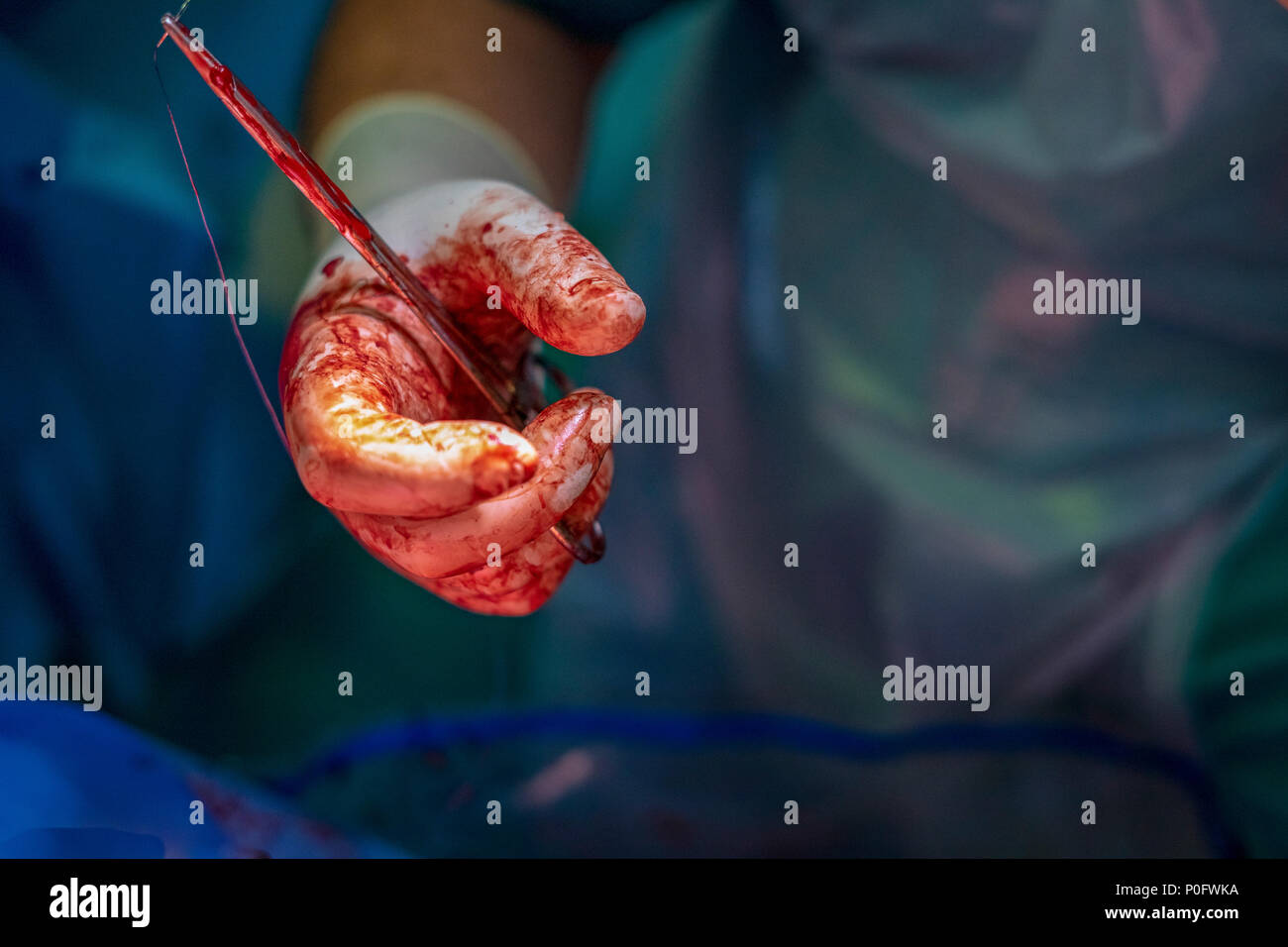 Couture et de mettre des points de suture chirurgien après l'opération, en particulier après la naissance Banque D'Images