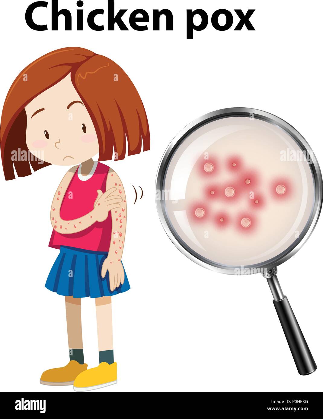 Jeune fille avec la varicelle illustration Illustration de Vecteur