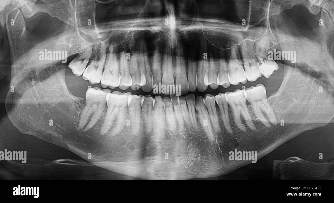Dentaire panoramique x-ray image de mâchoire avec toutes les dents montrant les obturations dentaires et des cavités Banque D'Images