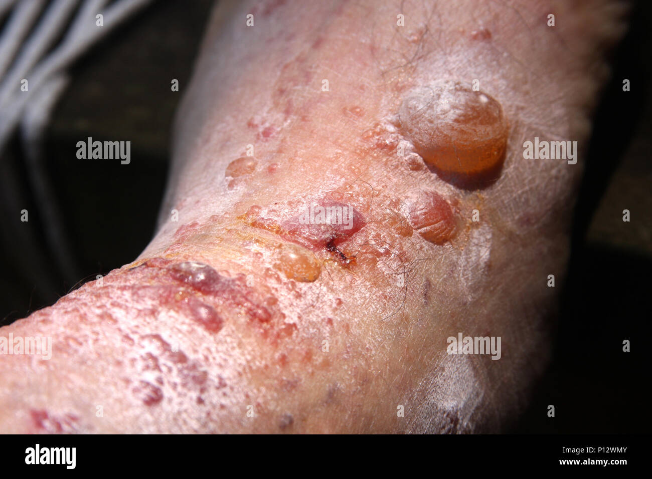 Close up de cloques sur le bras de l'homme, causée par une réaction allergique à l'herbe à puce Banque D'Images Close up de cloques sur le bras de l'homme, causée par une réaction allergique à l'herbe à puce Banque D'Images