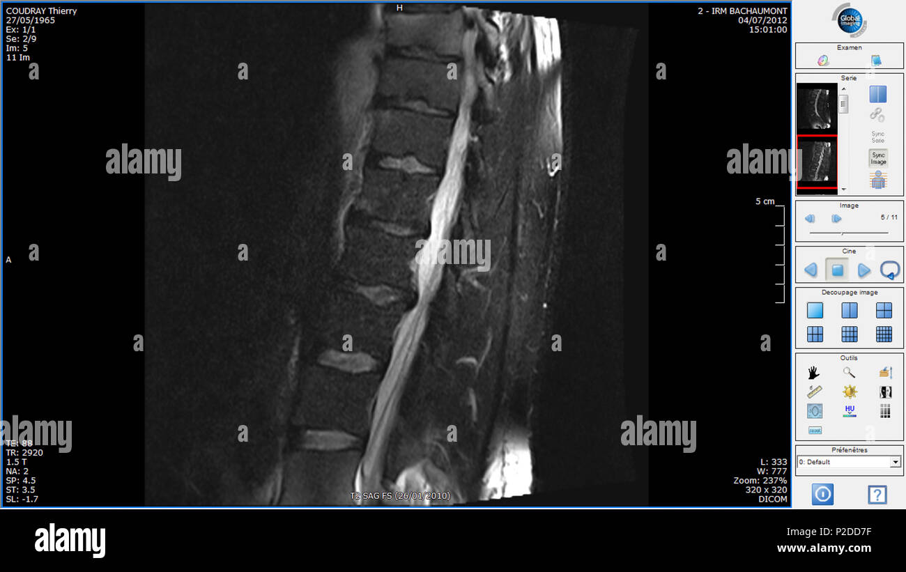 30 L4-L5 hernie Banque D'Images