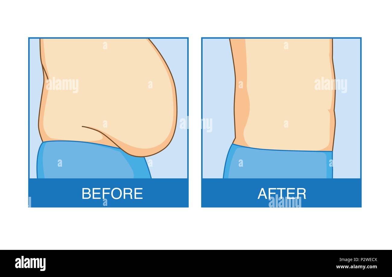 Avant et après de l'excès de graisse abdominale à plat. Illustration de Vecteur