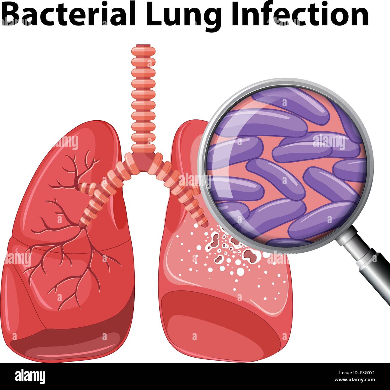 traitement pour une infection pulmonaire