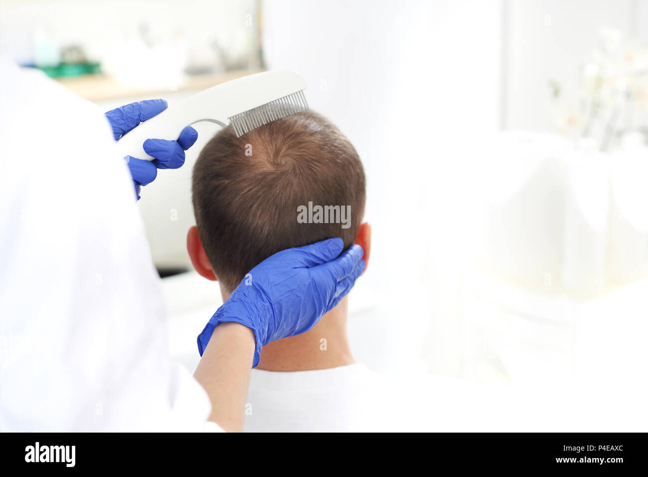 Traitement contre la perte de cheveux. Microneedle mésothérapie du cuir chevelu. La tête d'un homme avec des cheveux effilants pendant la mésothérapie d'aiguille Banque D'Images
