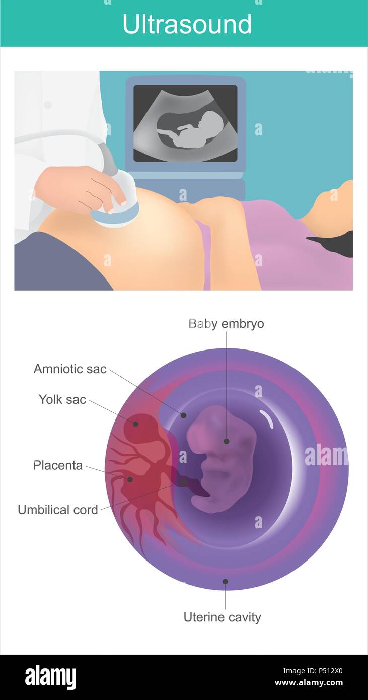 Bébé l'échographie. Utilisation d'ondes acoustiques de visualiser l'embryon dans la cavité utérine. Illustration de Vecteur