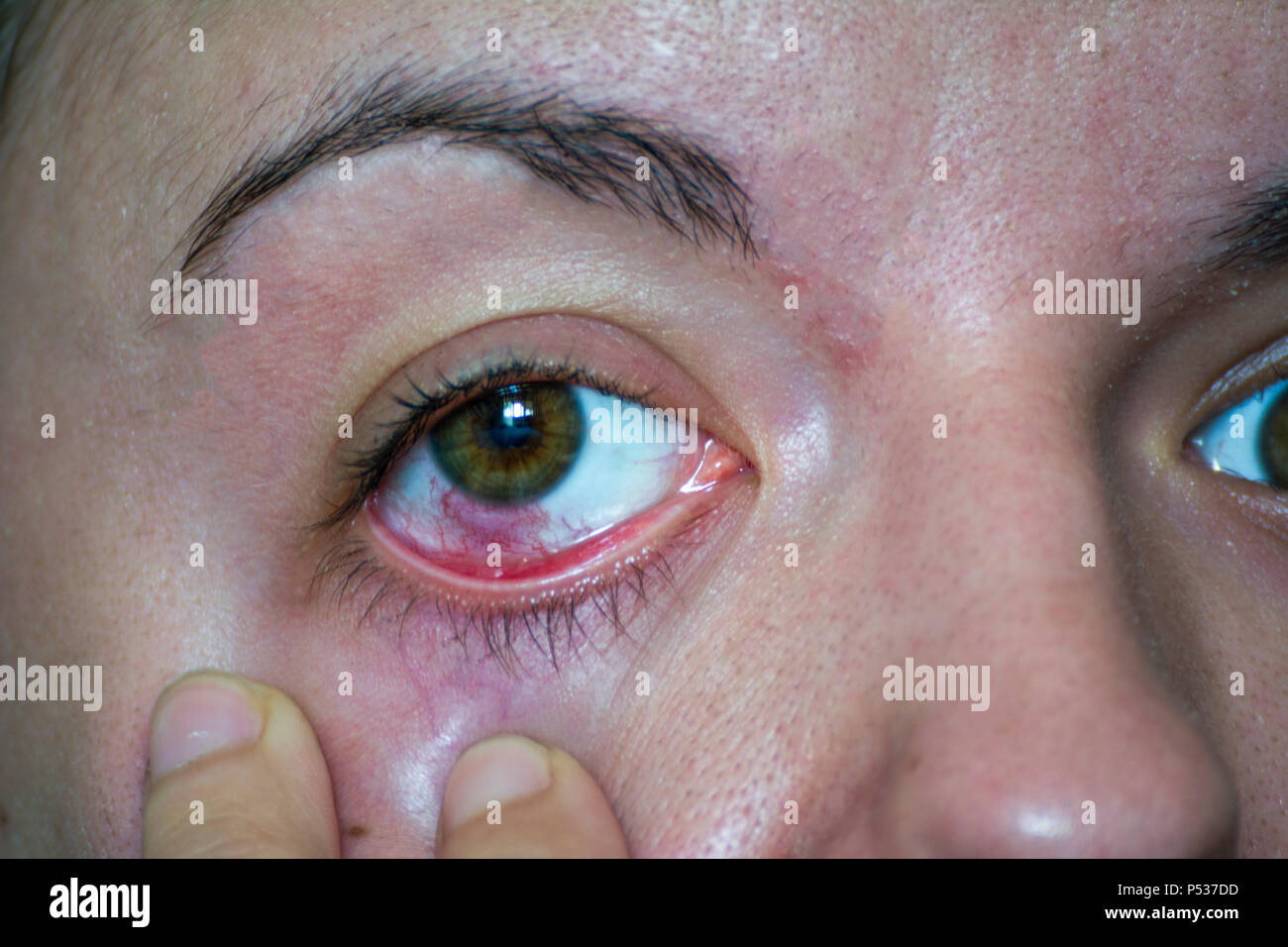 œil Injecte De Sang Yeux Banque D Image Et Photos Alamy
