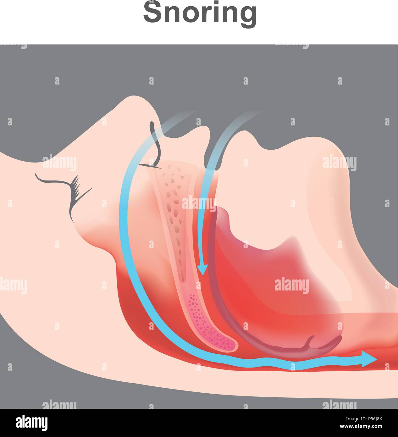 Le ronflement est la vibration de structures respiratoires et le son résultant en raison d'un mouvement d'air obstruées durant la respiration pendant le sommeil. Illustration de Vecteur