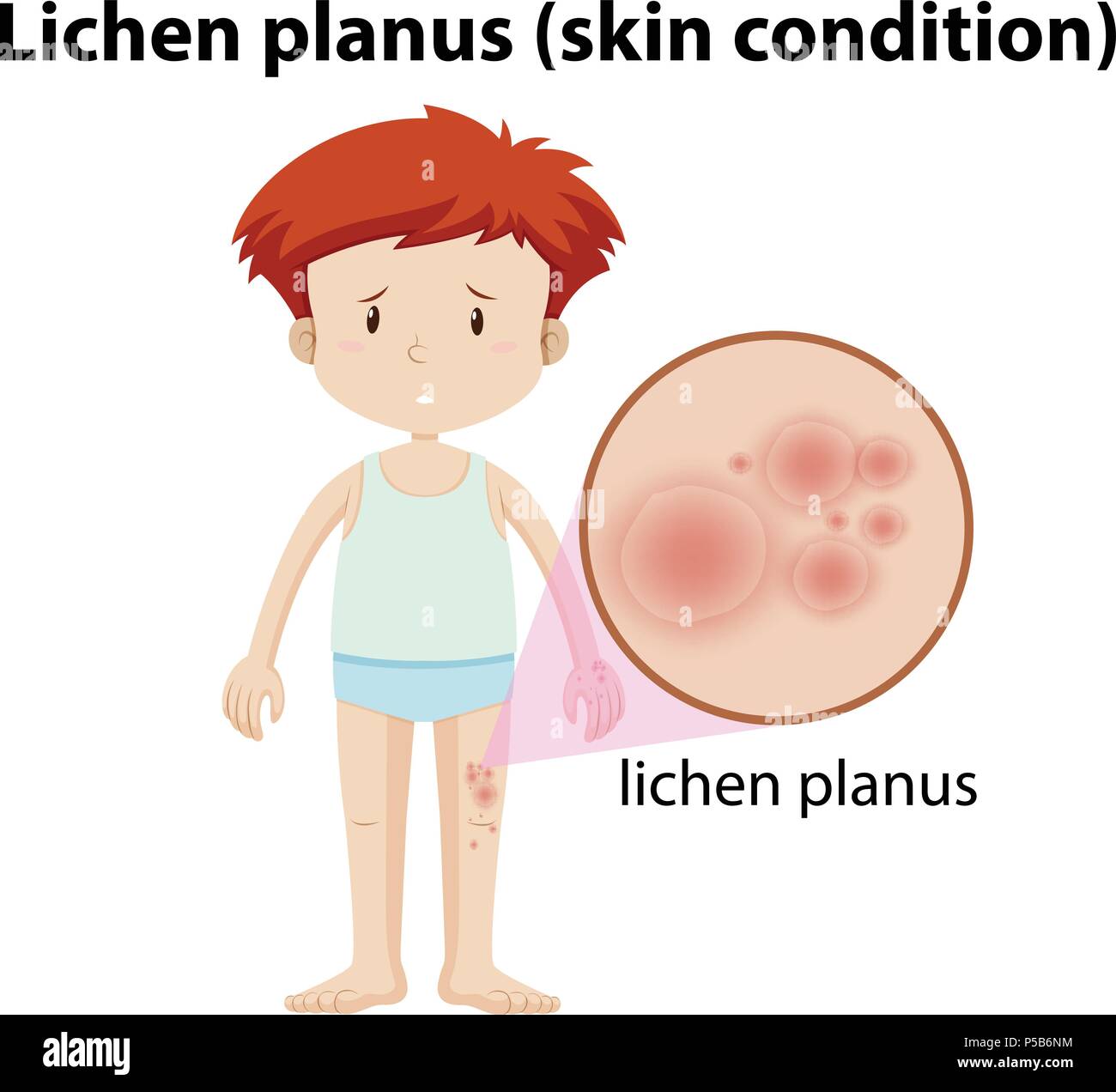 Un jeune homme ayant le Planus de lichen illustration Illustration de Vecteur