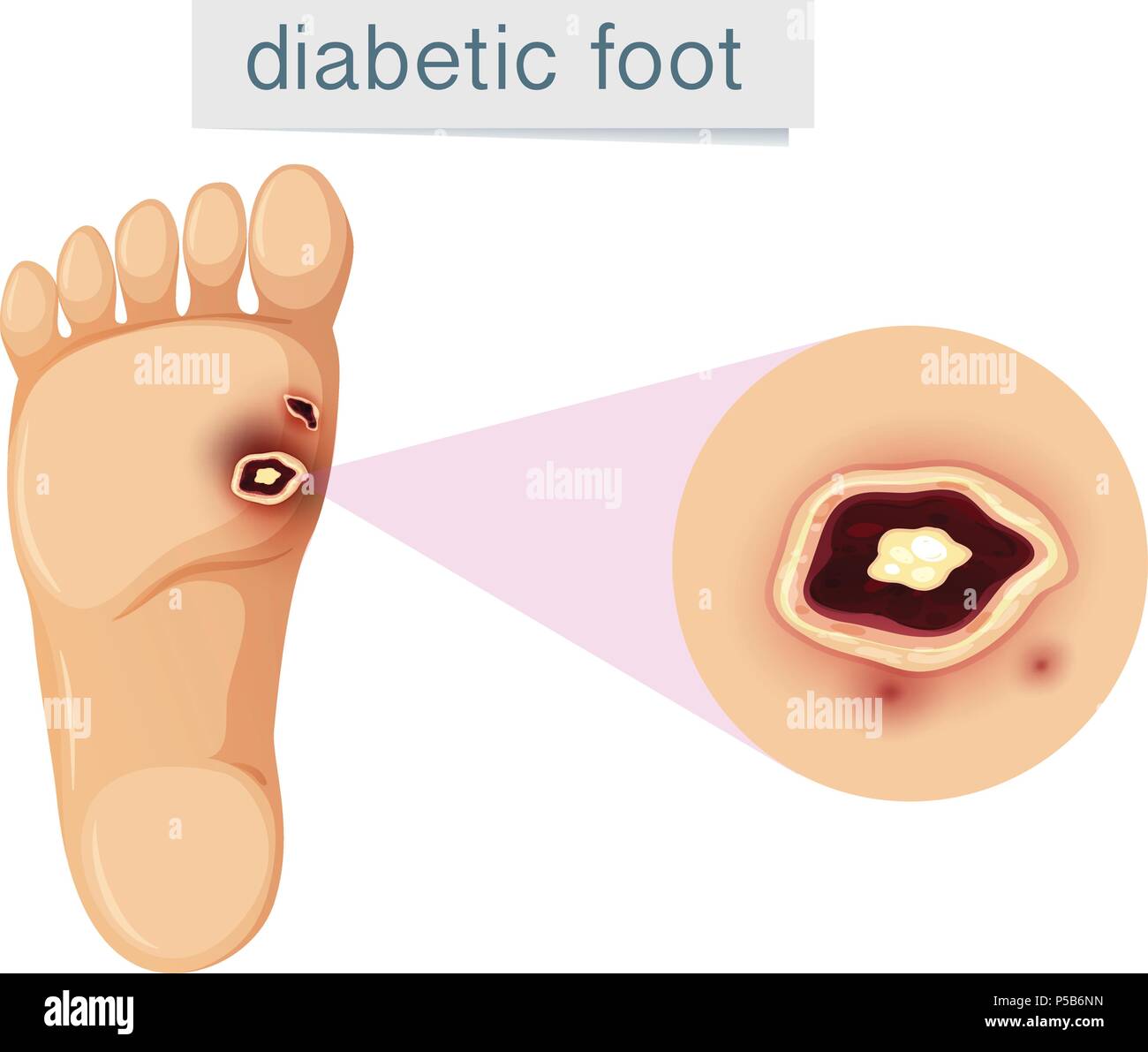 Un pied diabétique sur fond blanc illustration Illustration de Vecteur