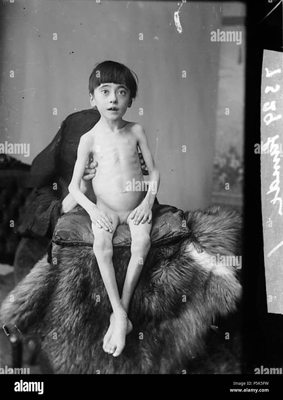 [Un enfant affamé] [GRAPHIC].. 1 : négatif verre, plaque sèche, n&b ; 11 x 8 cm. vers 1885. Thomas, John, un enfant affamé 46 ANL3362487 Banque D'Images