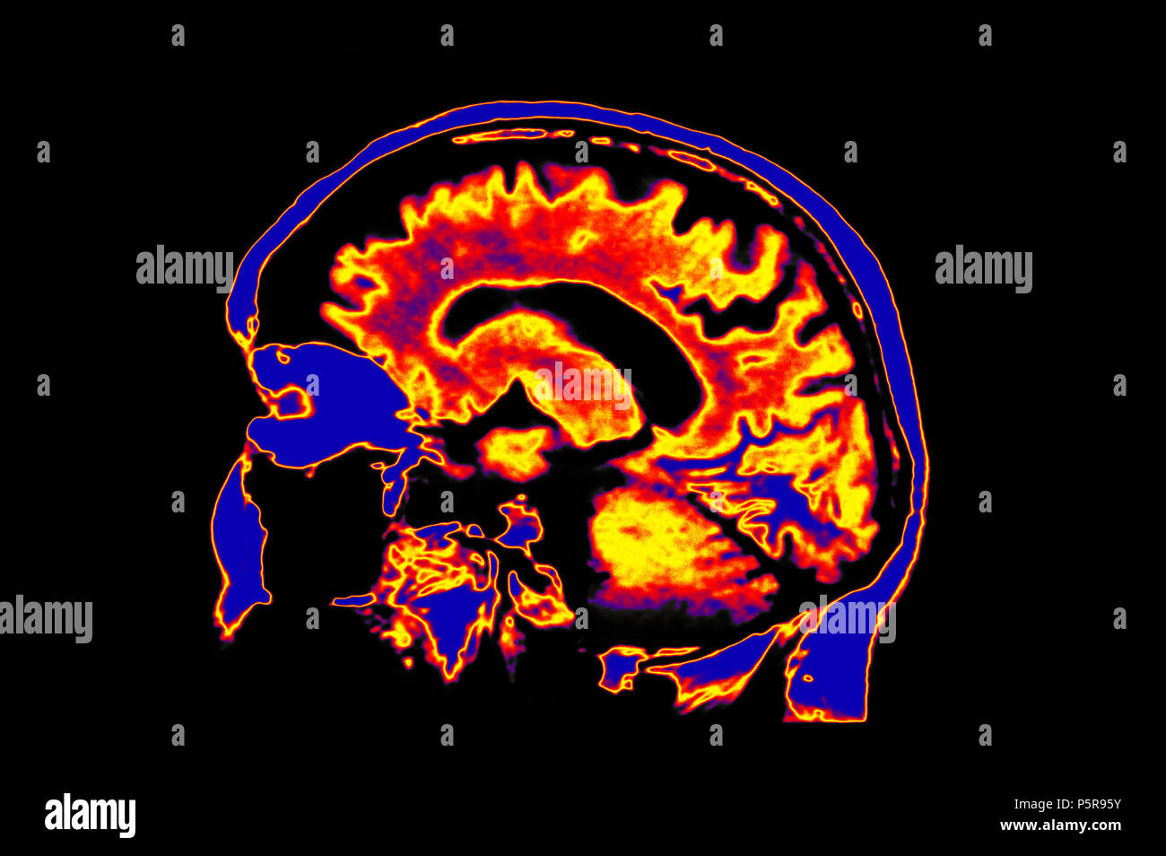 L'image IRM colorisée montrant la tête de cerveau Banque D'Images