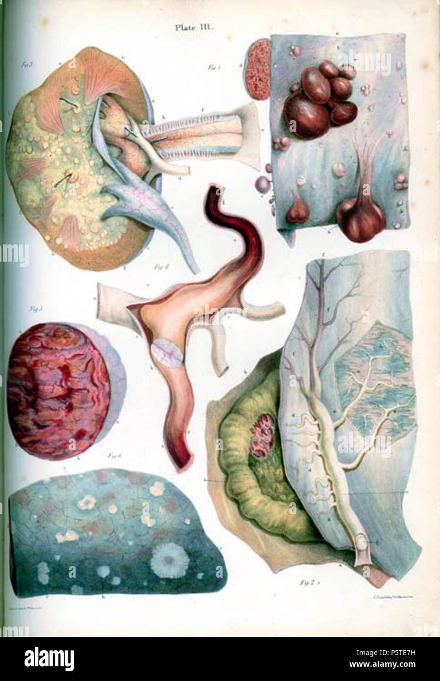 N/A. Anglais : Anatomie Pathologique des illustrations des formes élémentaires de la maladie . 8 janvier 2014, 04:49:34. Robert Carswell Carswell 3WF 277 carcinome Banque D'Images