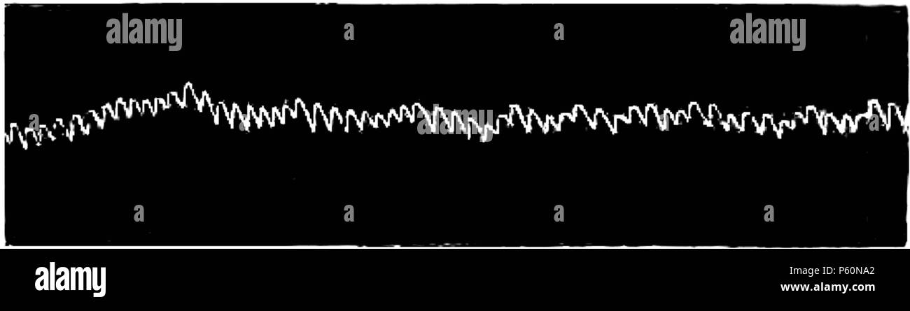 555 FI-D057-variation rythme cardiaque Banque D'Images