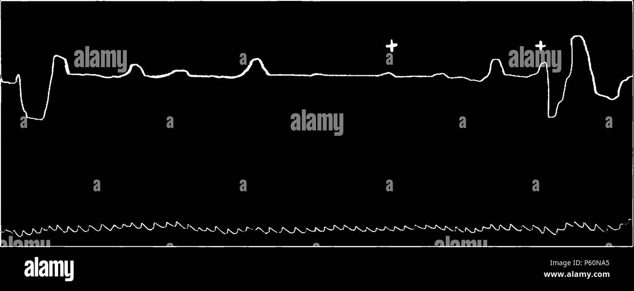 555 FI-D059-fig. 9 - variation du rythme cardiaque-3 Banque D'Images