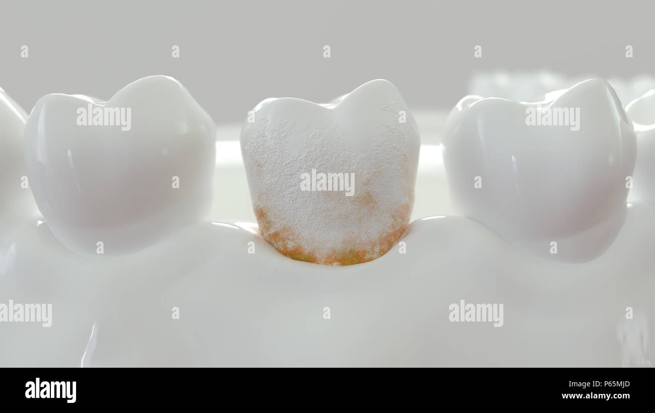 Strong plaque sur une molaire -- 3D Rendering Banque D'Images