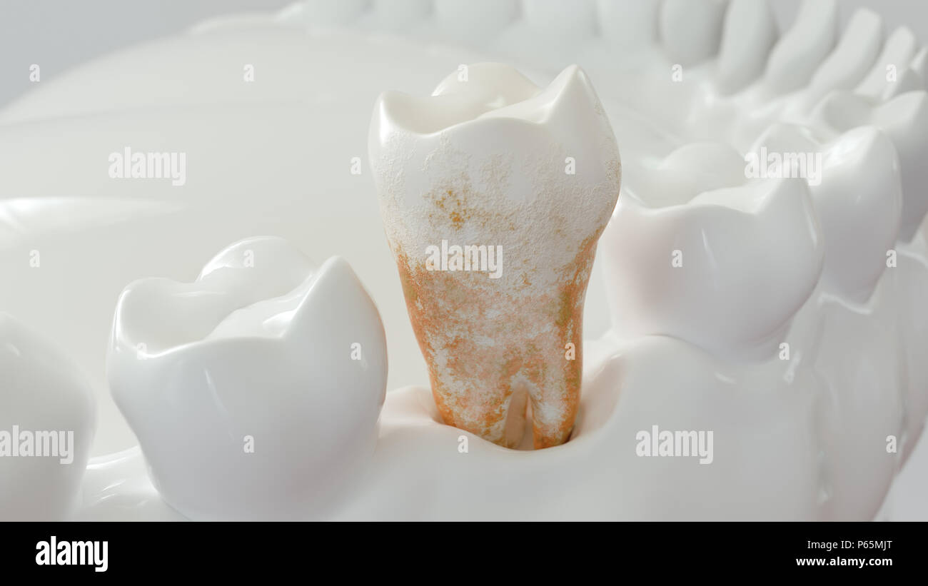 Strong plaque sur une molaire -- 3D Rendering Banque D'Images