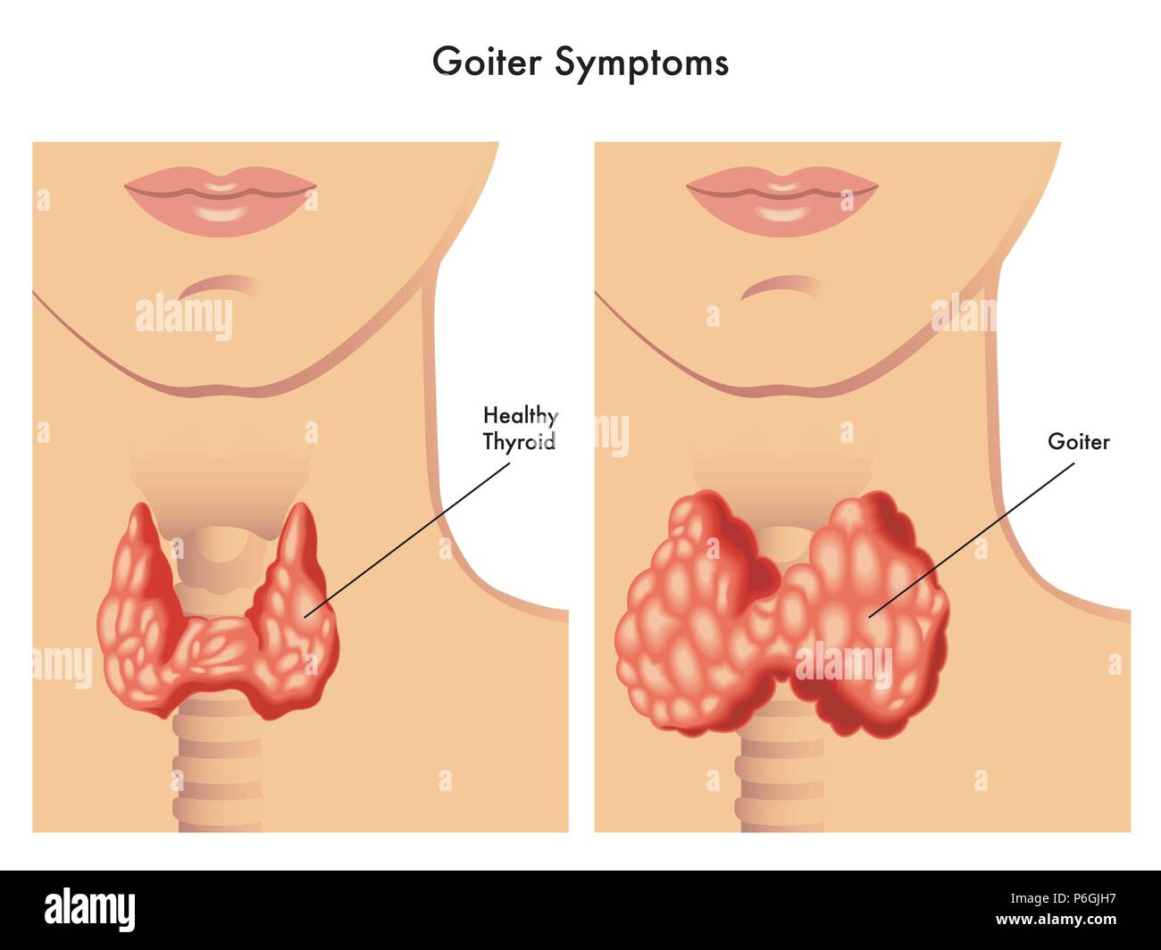 Vector illustration médicale des symptômes de goitre Illustration de Vecteur