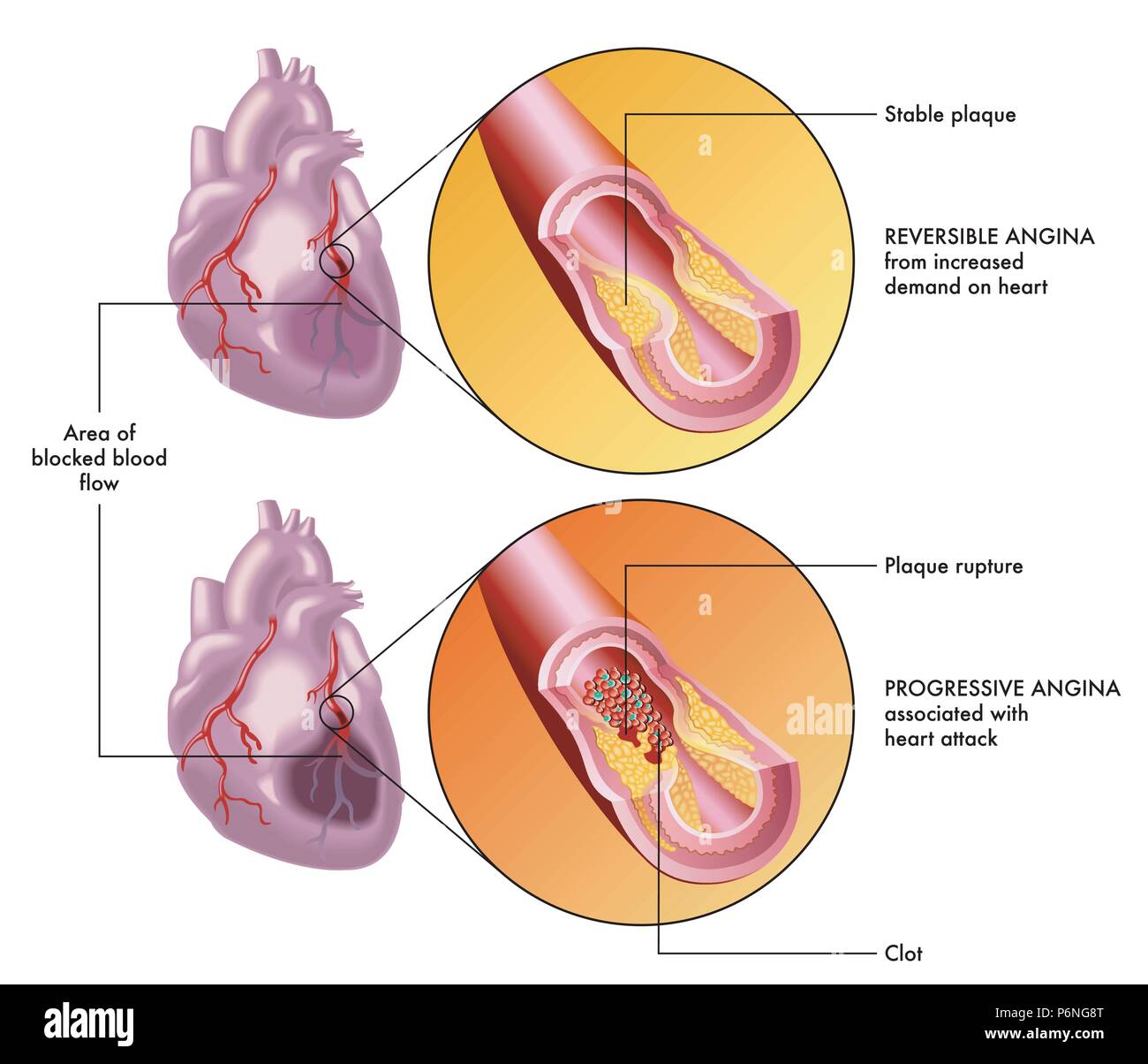 Un vecteur illustration médicale du cœur humain et les effets d'un réversible et une angine. Illustration de Vecteur