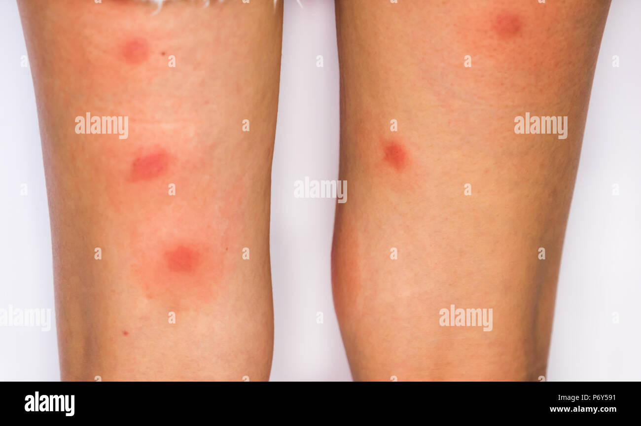 La jambe avec tache rouge causée par piqûre d'insecte / insectes morsure  sur la peau de la jambe / Insectes / sting piqûre d'Insecte Photo Stock -  Alamy