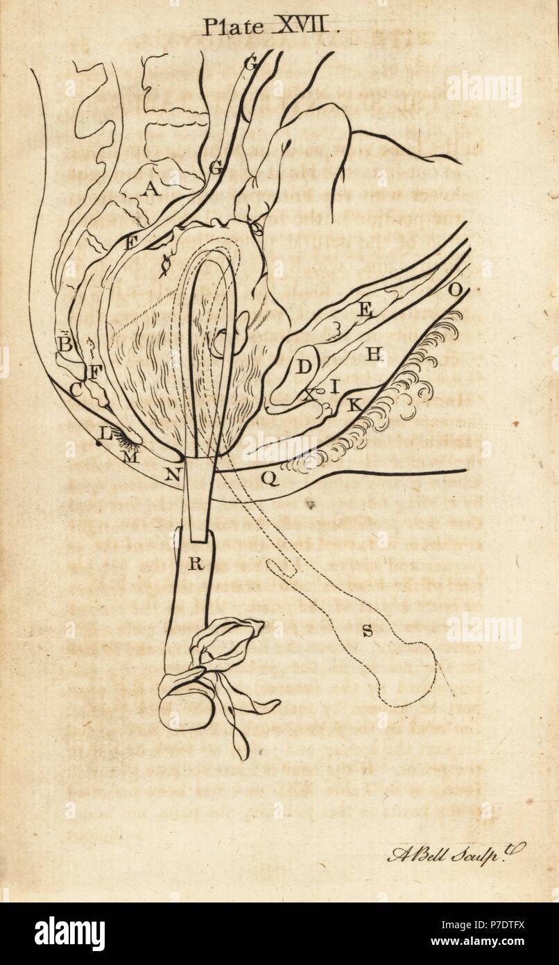 La tête du fœtus à travers le canal de naissance a aidé avec des pinces. La gravure sur cuivre par Andrew Bell après une illustration par Jan van Rymsdyk de William Smellie est un ensemble de tables anatomiques, Charles Elliot, Édimbourg, 1780. Banque D'Images
