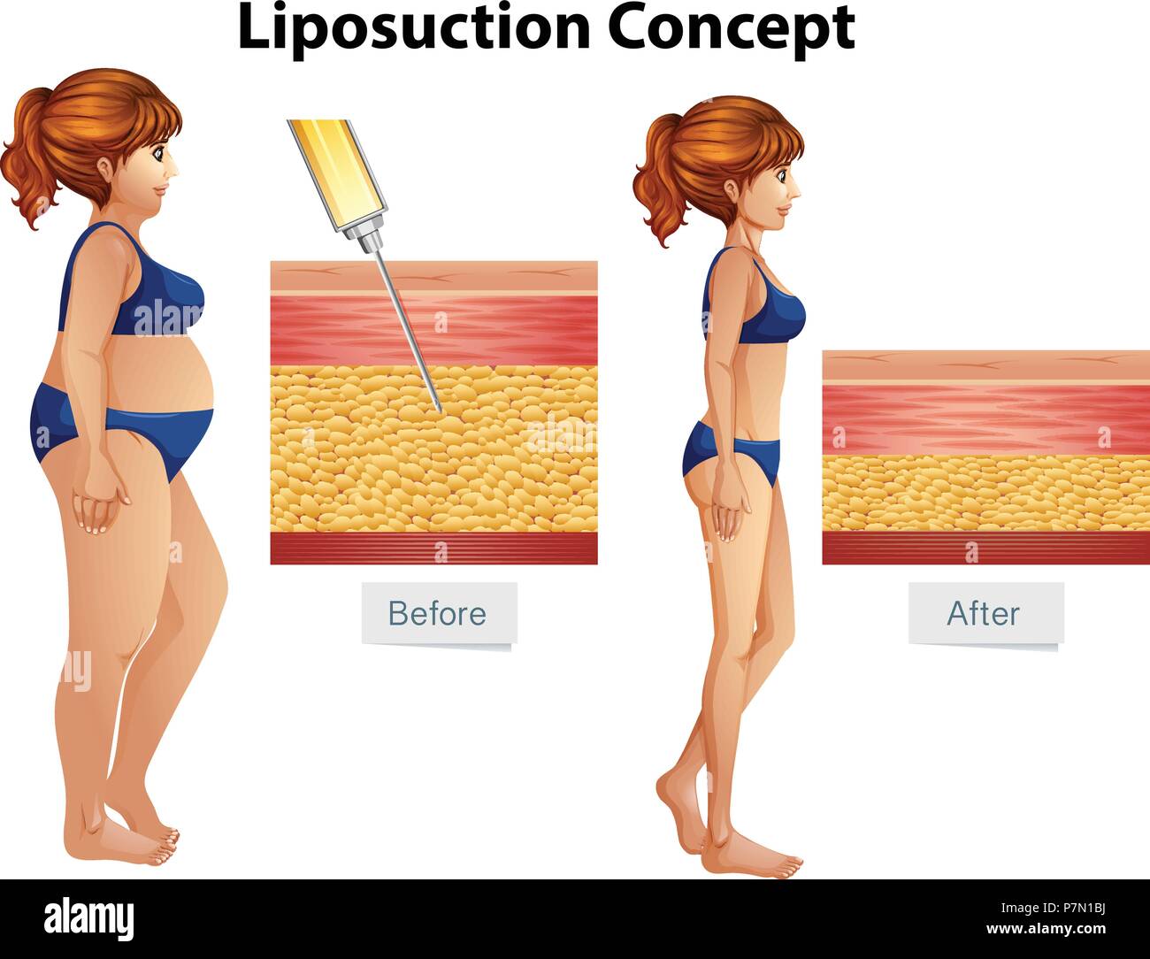 La liposuccion de l'illustration diagramme Concept Illustration de Vecteur