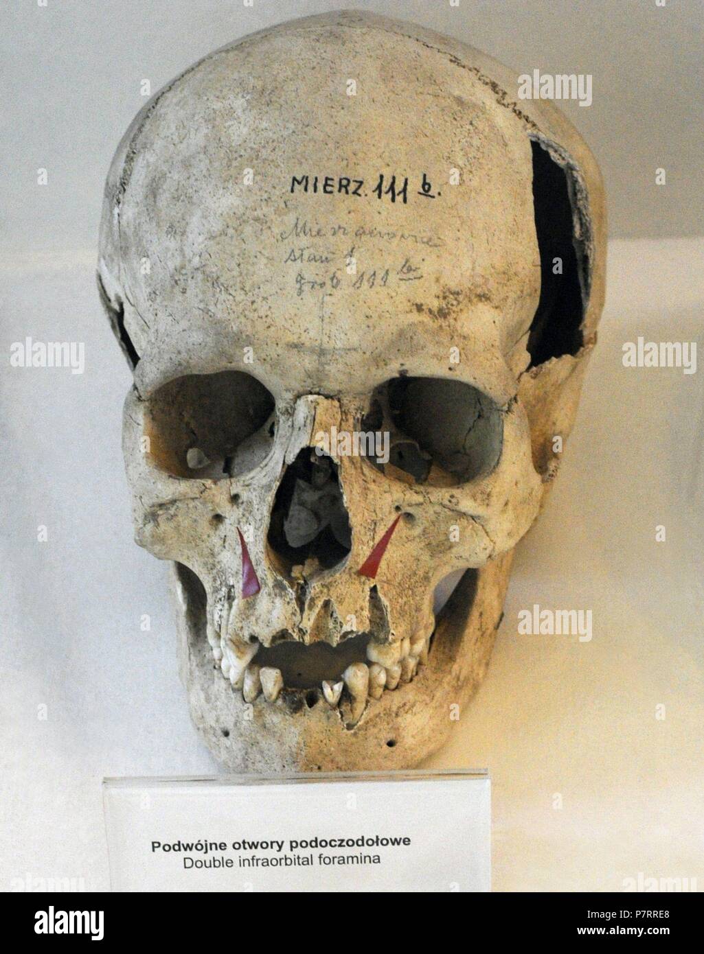 Crâne montrant le foramen infraorbital double dans l'os maxillaire. Situé au-dessous du foramen infraorbital marge, sous l'oeil. Musée archéologique. Gdansk. La Pologne. Banque D'Images