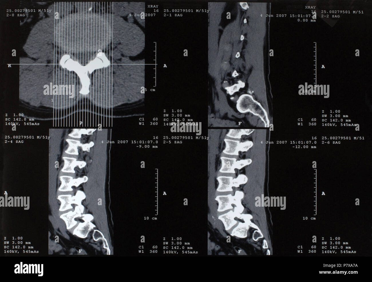Épine mâle xray Banque D'Images