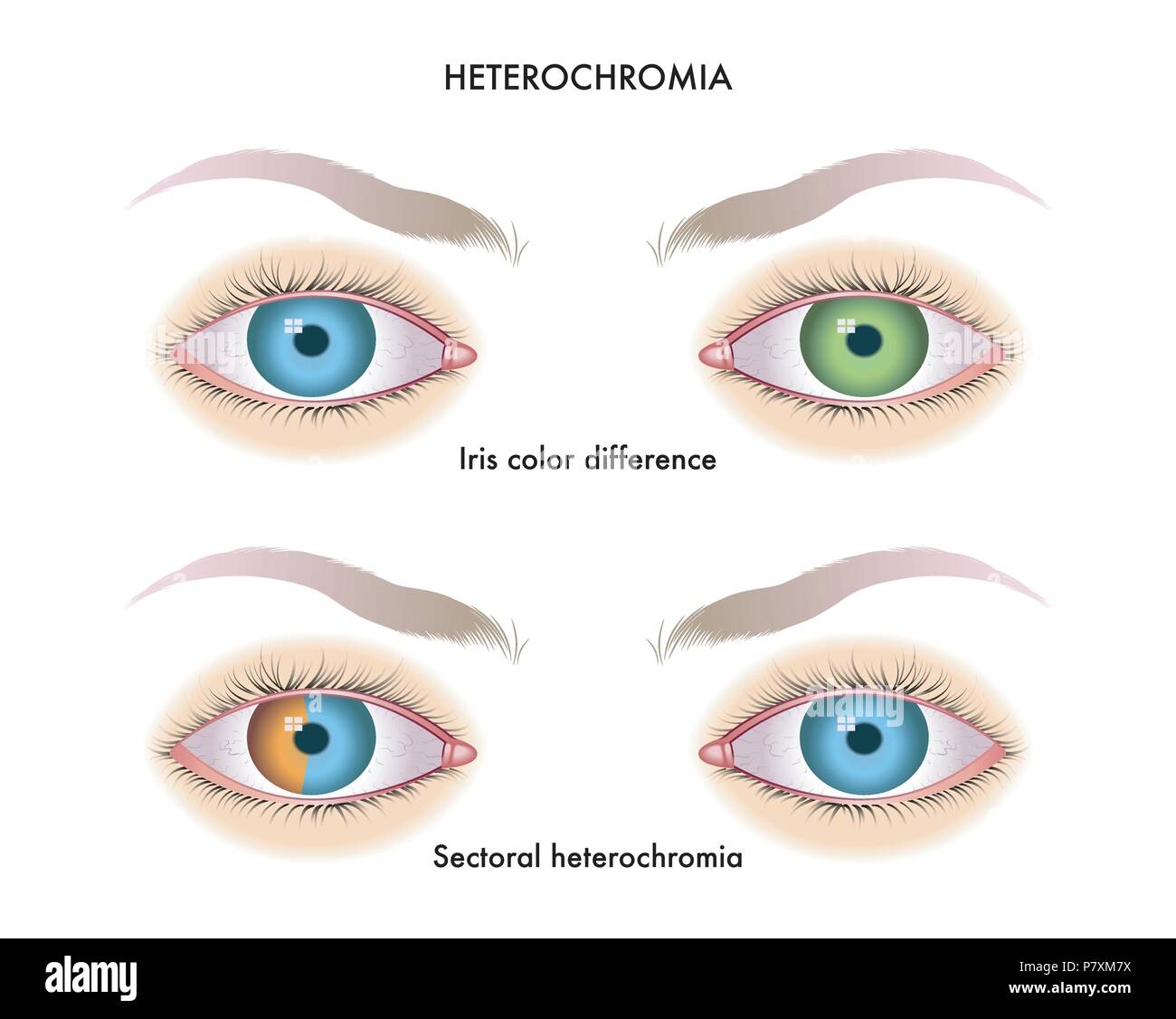 Vector illustration médicale des symptômes de heterochromia de l'iris Illustration de Vecteur