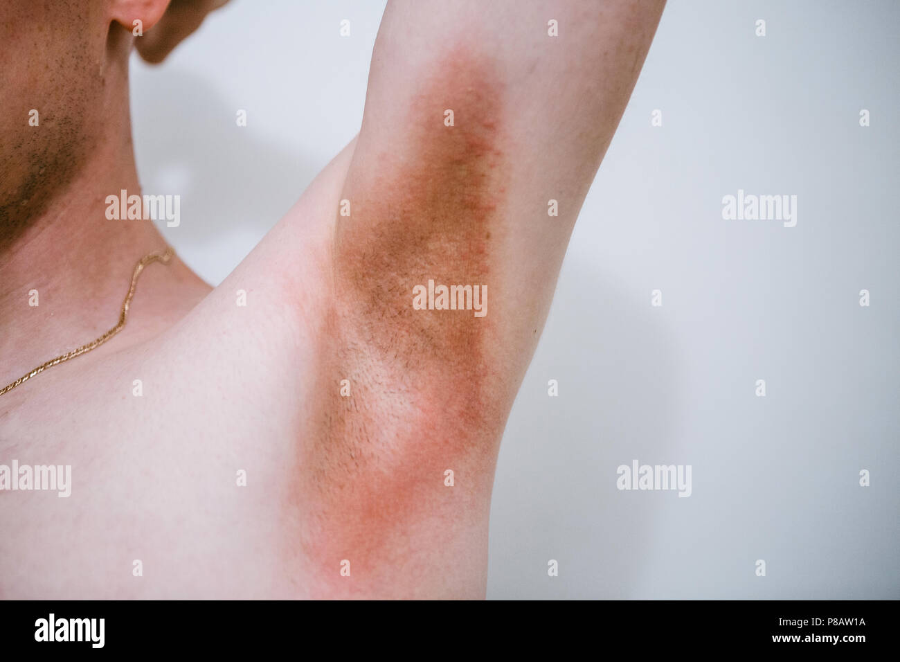 Un homme avec une maladie de peau dans la région de l'aisselle. La chaleur épineuse Banque D'Images