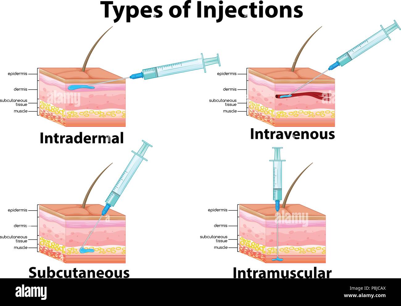 Neuf Il Injection Un ensemble de Type d'injection illustration Image Vectorielle Stock ...