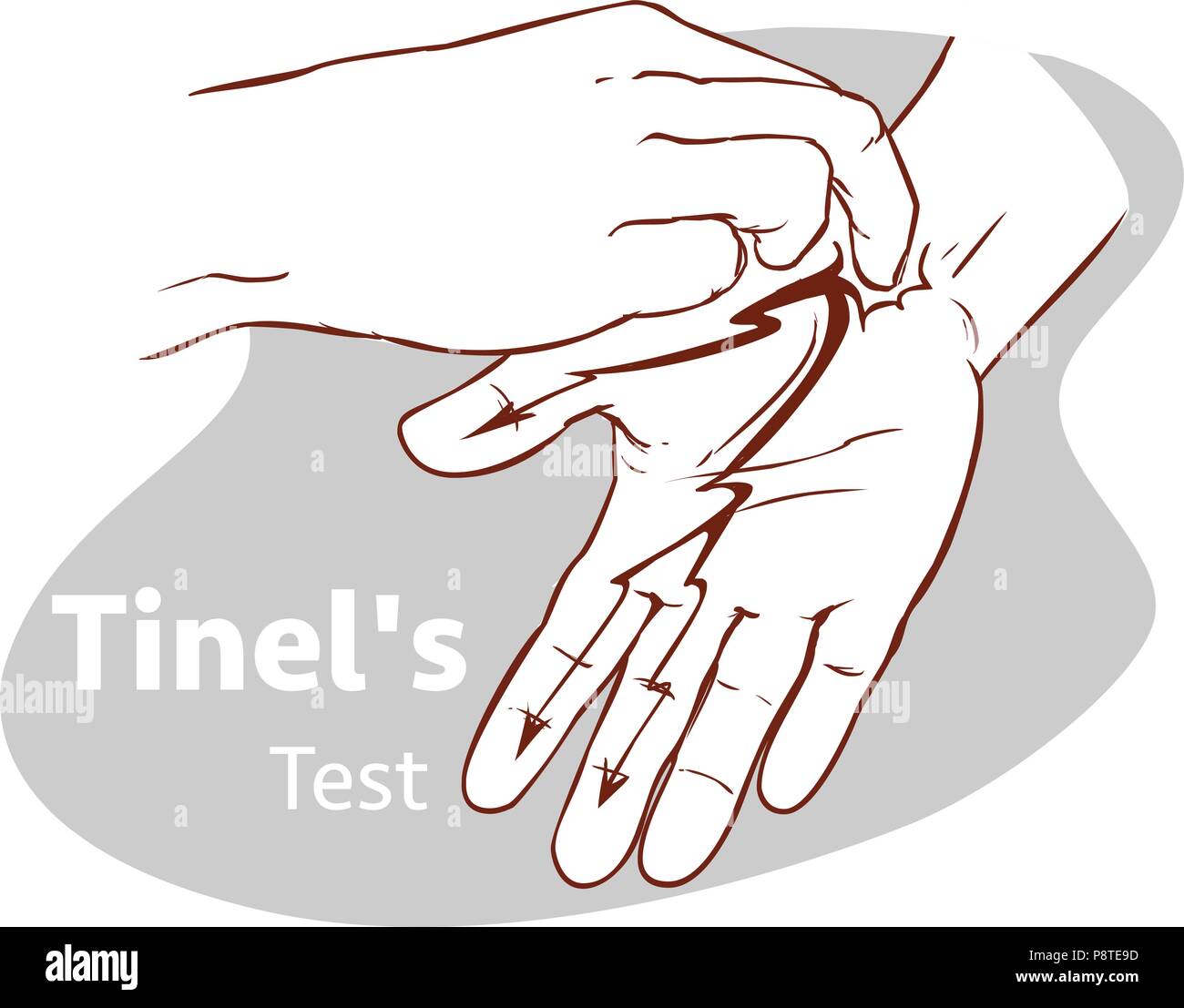 Vector illustration d'un test de Tinel Illustration de Vecteur